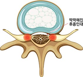 후종인대 골화증 횡단면 이미지