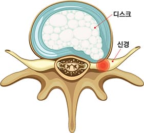 디스크 횡당면 이미지
