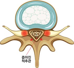 협착증 횡당면 이미지